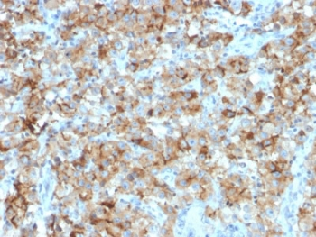 STAR Antibody - IHC staining of FFPE human testicular carcinoma with StAR antibody (clone STAR/2154). Required HIER: boil tissue sections in 10mM citrate buffer, pH 6, for 10-20 min followed by cooling at RT for 20 min.
