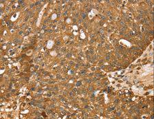 STARD5 Antibody - Immunohistochemistry of paraffin-embedded Human breast cancer using STARD5 Polyclonal Antibody at dilution of 1:40.