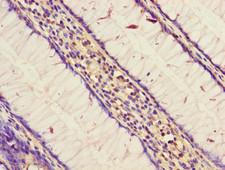 STARD9 Antibody - Immunohistochemistry of paraffin-embedded human colon cancer using STARD9 Antibody at dilution of 1:100