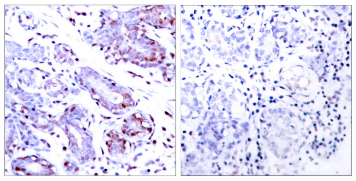 STAT1 Antibody - Immunohistochemistry analysis of paraffin-embedded human breast carcinoma tissue, using STAT1 Antibody. The picture on the right is blocked with the synthesized peptide.