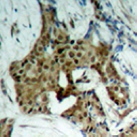 STAT1 Antibody - Immunohistochemical analysis of STAT1 (pY701) staining in human breast cancer formalin fixed paraffin embedded tissue section. The section was pre-treated using heat mediated antigen retrieval with sodium citrate buffer (pH 6.0). The section was then incubated with the antibody at room temperature and detected using an HRP conjugated compact polymer system. DAB was used as the chromogen. The section was then counterstained with hematoxylin and mounted with DPX.