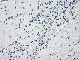 STAT1 Antibody - IHC of paraffin-embedded Carcinoma of thyroid tissue using anti-STAT1 mouse monoclonal antibody. (Dilution 1:50).