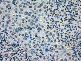 STAT1 Antibody - IHC of paraffin-embedded Adenocarcinoma of breast tissue using anti-STAT1 mouse monoclonal antibody. (Dilution 1:50).