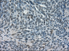 STAT1 Antibody - IHC of paraffin-embedded Adenocarcinoma of ovary tissue using anti-STAT1 mouse monoclonal antibody. (Dilution 1:50).