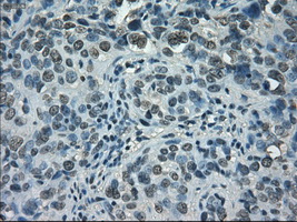STAT1 Antibody - IHC of paraffin-embedded Carcinoma of bladder tissue using anti-STAT1 mouse monoclonal antibody. (Dilution 1:50).