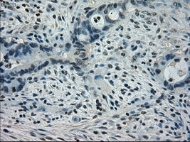 STAT1 Antibody - IHC of paraffin-embedded Adenocarcinoma of colon tissue using anti-STAT1 mouse monoclonal antibody. (Dilution 1:50).
