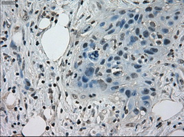 STAT1 Antibody - IHC of paraffin-embedded Carcinoma of pancreas tissue using anti-STAT1 mouse monoclonal antibody. (Dilution 1:50).