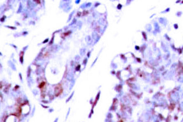 STAT1 Antibody - IHC of STAT1 (G695) pAb in paraffin-embedded human breast carcinoma tissue.