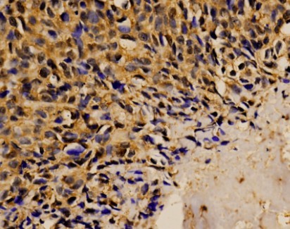 STAT1 Antibody - IHC of Stat1 pAb in paraffin-embedded human breast carcinoma tissue.