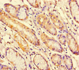 STAT1 Antibody - Immunohistochemistry of paraffin-embedded human gastric cancer at dilution of 1:100