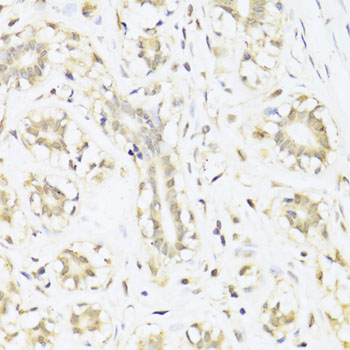 STAT1 Antibody - Immunohistochemistry of paraffin-embedded human mammary cancer using STAT1 antibody at dilution of 1:100 (40x lens).