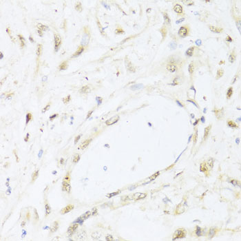 STAT1 Antibody - Immunohistochemistry of paraffin-embedded human gastric cancer using STAT1 antibody at dilution of 1:100 (40x lens).