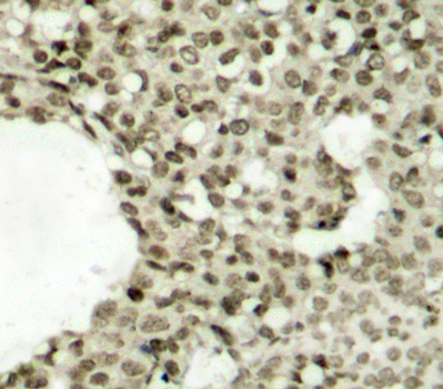 STAT1 Antibody - Immunohistochemical analysis of paraffin-embedded human breast carcinoma tissue.