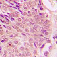 STAT1 Antibody - Immunohistochemical analysis of STAT1 (pS727) staining in human breast cancer formalin fixed paraffin embedded tissue section. The section was pre-treated using heat mediated antigen retrieval with sodium citrate buffer (pH 6.0). The section was then incubated with the antibody at room temperature and detected using an HRP conjugated compact polymer system. DAB was used as the chromogen. The section was then counterstained with hematoxylin and mounted with DPX.