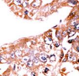 STAT1 Antibody - Formalin-fixed and paraffin-embedded human cancer tissue reacted with the primary antibody, which was peroxidase-conjugated to the secondary antibody, followed by AEC staining. This data demonstrates the use of this antibody for immunohistochemistry; clinical relevance has not been evaluated. BC = breast carcinoma; HC = hepatocarcinoma.