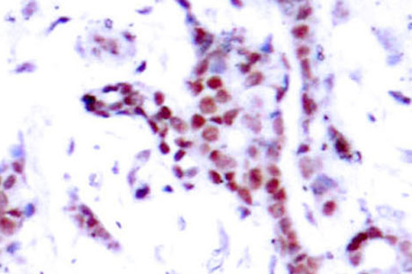 STAT1 Antibody - IHC of p-STAT1 (Y701) pAb in paraffin-embedded human breast carcinoma tissue.