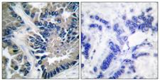 STAT2 Antibody - Immunohistochemistry analysis of paraffin-embedded human lung carcinoma tissue, using STAT2 Antibody. The picture on the right is blocked with the synthesized peptide.