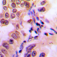 STAT2 Antibody - Immunohistochemical analysis of STAT2 (pY690) staining in human breast cancer formalin fixed paraffin embedded tissue section. The section was pre-treated using heat mediated antigen retrieval with sodium citrate buffer (pH 6.0). The section was then incubated with the antibody at room temperature and detected using an HRP-conjugated compact polymer system. DAB was used as the chromogen. The section was then counterstained with hematoxylin and mounted with DPX.
