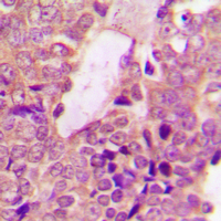 STAT2 Antibody - Immunohistochemical analysis of STAT2 staining in human breast cancer formalin fixed paraffin embedded tissue section. The section was pre-treated using heat mediated antigen retrieval with sodium citrate buffer (pH 6.0). The section was then incubated with the antibody at room temperature and detected using an HRP conjugated compact polymer system. DAB was used as the chromogen. The section was then counterstained with hematoxylin and mounted with DPX.