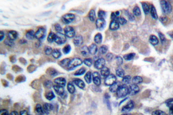 STAT2 Antibody - IHC of STAT2 (L684) pAb in paraffin-embedded human lung carcinoma tissue.