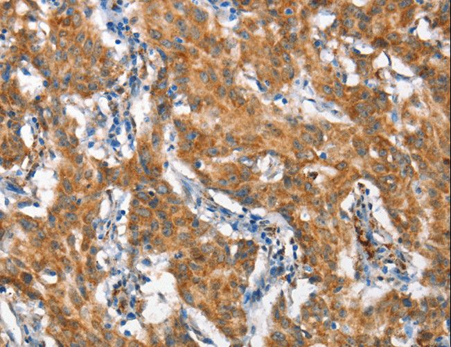 STAT2 Antibody - Immunohistochemistry of paraffin-embedded Human gastric cancer using STAT2 Polyclonal Antibody at dilution of 1:60.