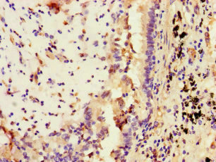 STAT2 Antibody - Immunohistochemistry of paraffin-embedded human lung cancer at dilution of 1:100