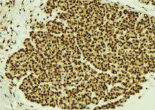 STAT2 Antibody - 1:100 staining human breast carcinoma tissue by IHC-P. The sample was formaldehyde fixed and a heat mediated antigen retrieval step in citrate buffer was performed. The sample was then blocked and incubated with the antibody for 1.5 hours at 22°C. An HRP conjugated goat anti-rabbit antibody was used as the secondary.