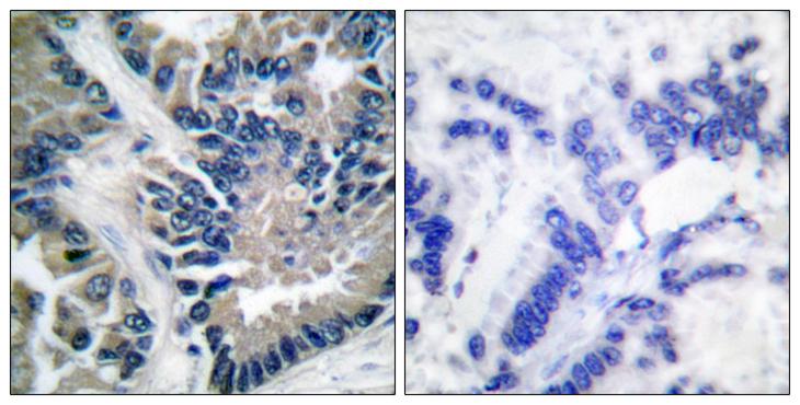 STAT2 Antibody - Peptide - + Immunohistochemical analysis of paraffin-embedded human lung carcinoma tissue using STAT2 (Ab-690) antibody.