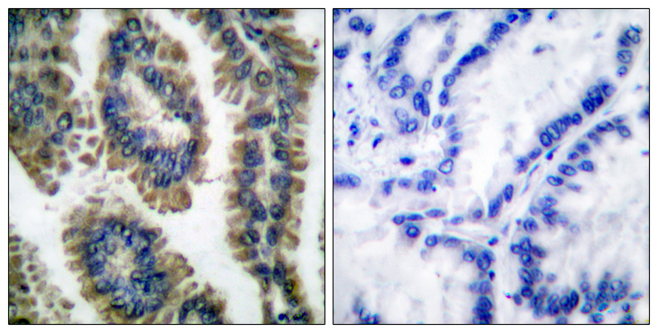 STAT2 Antibody - Immunohistochemistry analysis of paraffin-embedded human lung carcinoma, using STAT2 (Phospho-Tyr690) Antibody. The picture on the right is blocked with the phospho peptide.