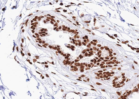 STAT2 Antibody - 1:100 staining human breast carcinoma tissue by IHC-P. The tissue was formaldehyde fixed and a heat mediated antigen retrieval step in citrate buffer was performed. The tissue was then blocked and incubated with the antibody for 1.5 hours at 22°C. An HRP conjugated goat anti-rabbit antibody was used as the secondary.