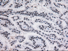 STAT3 Antibody - IHC of paraffin-embedded Carcinoma of kidney using anti-STAT3 mouse monoclonal antibody.