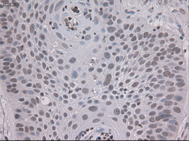 STAT3 Antibody - IHC of paraffin-embedded Carcinoma of lung using anti-STAT3 mouse monoclonal antibody.