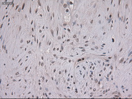 STAT3 Antibody - IHC of paraffin-embedded Carcinoma of pancreas using anti-STAT3 mouse monoclonal antibody.