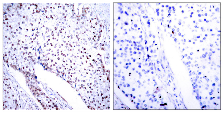 STAT3 Antibody - Immunohistochemistry analysis of paraffin-embedded human breast carcinoma tissue, using STAT3 Antibody. The picture on the right is blocked with the synthesized peptide.