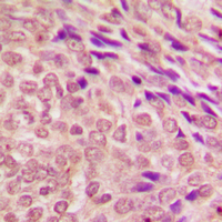 STAT3 Antibody - Immunohistochemical analysis of STAT3 staining in human breast cancer formalin fixed paraffin embedded tissue section. The section was pre-treated using heat mediated antigen retrieval with sodium citrate buffer (pH 6.0). The section was then incubated with the antibody at room temperature and detected using an HRP conjugated compact polymer system. DAB was used as the chromogen. The section was then counterstained with hematoxylin and mounted with DPX.