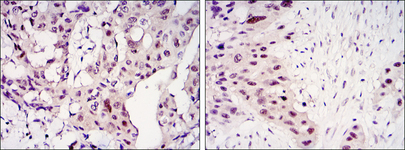 STAT3 Antibody - IHC of paraffin-embedded mammary cancer tissues (left) and lung cancer tissues (right) using STAT3 mouse monoclonal antibody with DAB staining.