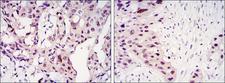 STAT3 Antibody - IHC of paraffin-embedded mammary cancer tissues (left) and lung cancer tissues (right) using STAT3 mouse monoclonal antibody with DAB staining.