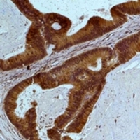 STAT3 Antibody - Immunohistochemical analysis of STAT3 staining in human colon cancer;mouse brain formalin fixed paraffin embedded tissue section. The section was pre-treated using heat mediated antigen retrieval with sodium citrate buffer (pH 6.0). The section was then incubated with the antibody at room temperature and detected using an HRP conjugated compact polymer system. DAB was used as the chromogen. The section was then counterstained with hematoxylin and mounted with DPX.