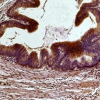 STAT3 Antibody - Immunohistochemical analysis of STAT3 staining in human colon cancer;mouse brain formalin fixed paraffin embedded tissue section. The section was pre-treated using heat mediated antigen retrieval with sodium citrate buffer (pH 6.0). The section was then incubated with the antibody at room temperature and detected using an HRP conjugated compact polymer system. DAB was used as the chromogen. The section was then counterstained with hematoxylin and mounted with DPX.