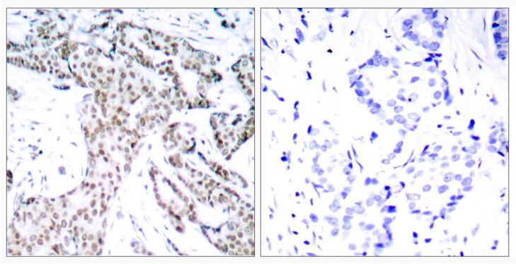 STAT3 Antibody - Immunohistochemistry analysis of paraffin-embedded human breast carcinoma, using STAT3 (Phospho-Ser727) Antibody. The picture on the right is blocked with the phospho peptide.