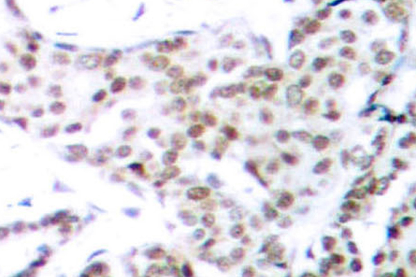 STAT3 Antibody - IHC of p-STAT3 (S727) pAb in paraffin-embedded human breast carcinoma tissue.