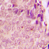 STAT3 Antibody - Immunohistochemical analysis of STAT3 (pS727) staining in human breast cancer formalin fixed paraffin embedded tissue section. The section was pre-treated using heat mediated antigen retrieval with sodium citrate buffer (pH 6.0). The section was then incubated with the antibody at room temperature and detected using an HRP conjugated compact polymer system. DAB was used as the chromogen. The section was then counterstained with hematoxylin and mounted with DPX.