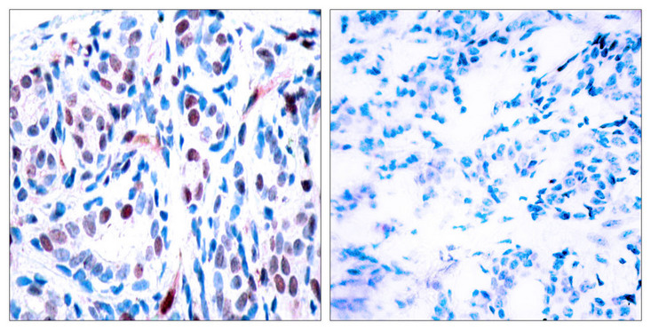 STAT3 Antibody - Immunohistochemistry analysis of paraffin-embedded human breast carcinoma, using STAT3 (Phospho-Tyr705) Antibody. The picture on the right is blocked with the phospho peptide.