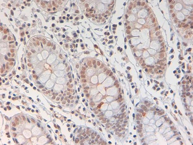 STAT3 Antibody - Immunohistochemistry of Rabbit anti STAT3 pY705 Antibody. Tissue: Human Colon at 40X in colon tissue at pH 9. Fixation: formalin fixed paraffin embedded. Antigen retrieval: not required. Primary antibody: STAT3 pY705 antibody at 10 µg/mL for 1 h at RT. Secondary antibody: Peroxidase rabbit secondary antibody at 1:10,000 for 45 min at RT. Localization: STAT3 phospho Y705 is nuclear and cytoplasmic. Staining: STAT3 (pTyr705) as precipitated red signal with hematoxylin purple nuclear counterstain.