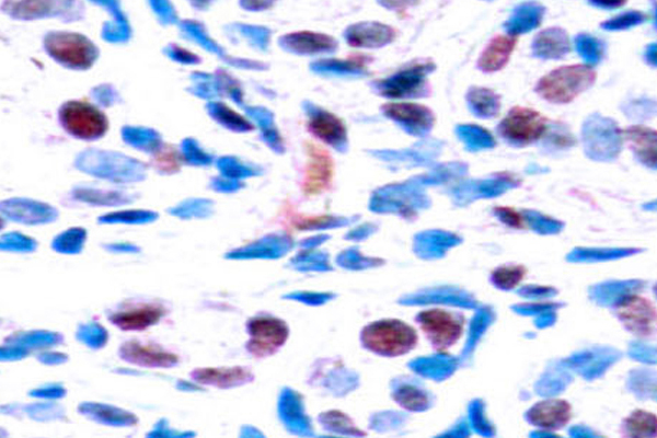 STAT3 Antibody - IHC of p-STAT3 (Y705) pAb in paraffin-embedded human breast carcinoma tissue.