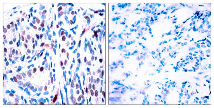 STAT3 Antibody - P-Peptide - + Immunohistochemical analysis of paraffin-embedded human breast carcinoma tissue using STAT3 (phospho-Tyr705) antibody.