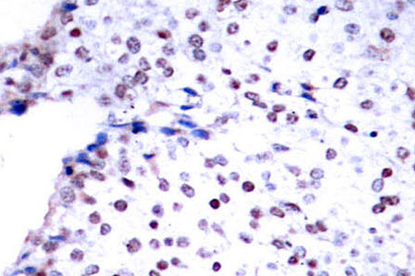 STAT3 Antibody - IHC of STAT3 (P699) pAb in paraffin-embedded human breast carcinoma tissue.