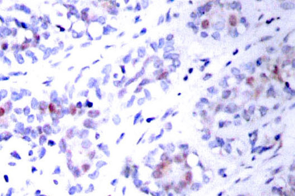 STAT3 Antibody - IHC of STAT3 (T721) pAb in paraffin-embedded human breast carcinoma tissue.