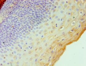 STAT4 Antibody - Immunohistochemistry of paraffin-embedded human cervical cancer using antibody at 1:100 dilution.