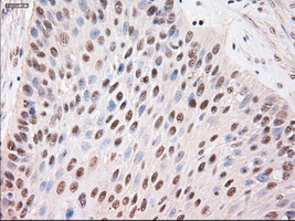 STAT4 Antibody - IHC of paraffin-embedded Carcinoma of lung using anti-Stat4 mouse monoclonal antibody.